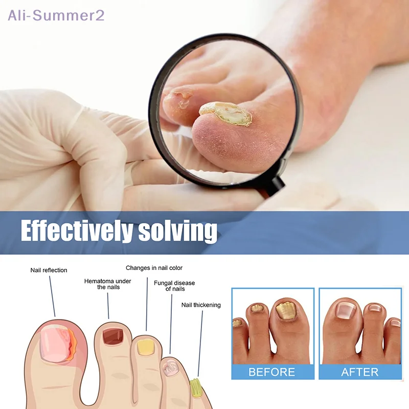 60 個の爪真菌パッチ粘着性ネイルリペアパッチ爪陥入矯正ステッカー足の爪ケア爪周囲炎ネイル治療パッチ