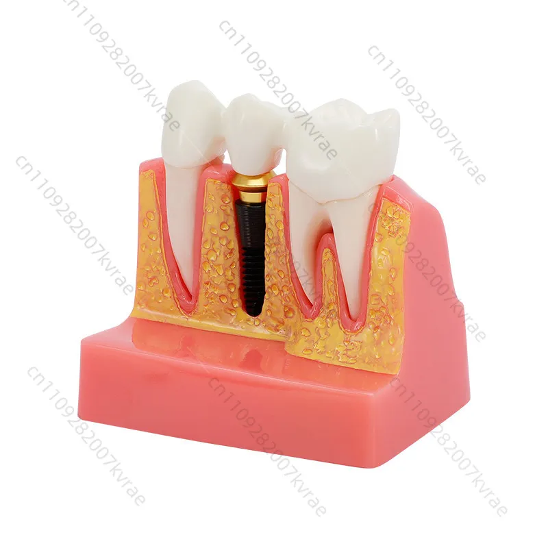 

teaching Implant teaching aids Removable full mouth teeth mold