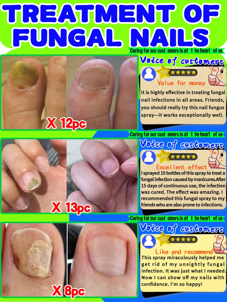 Las uñas pasan de estar opacas a transparentes. El spray para hongos en las uñas es testigo del milagro.