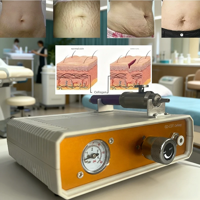 

CDT Co2 Carboxy Therapy Device For Localized Anti Cellulite Dark Circles Promotes Blood Circulation Home Appliances