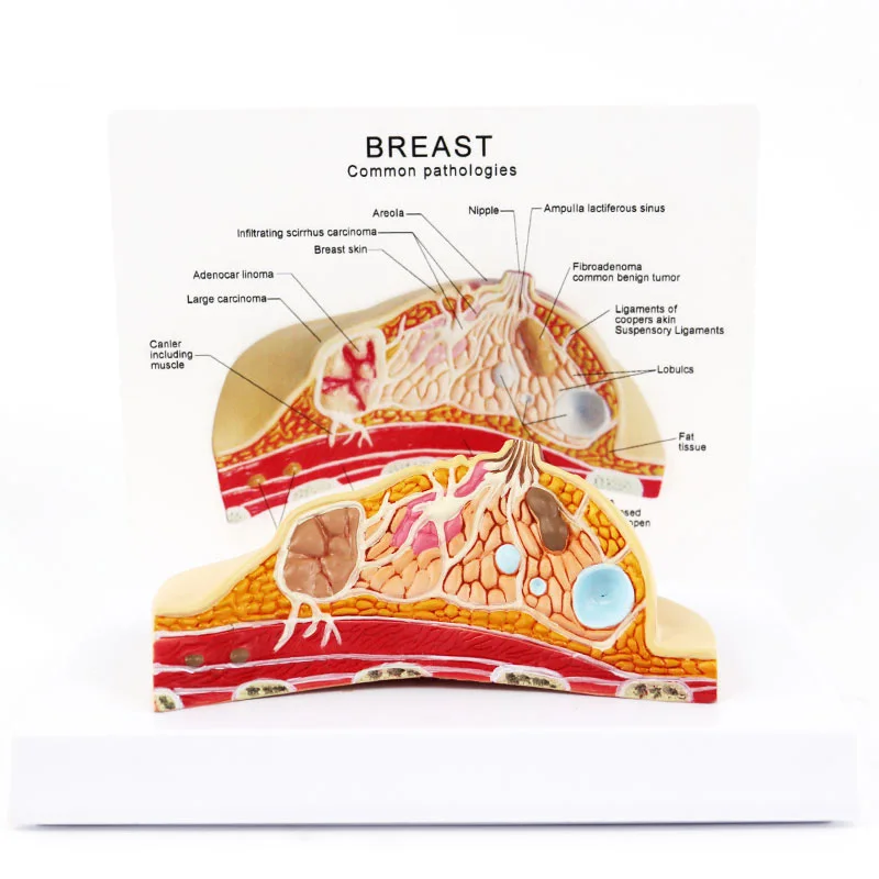 여성 의료 병리 질병 암 유방 해부학 모델, 인체 해부학
