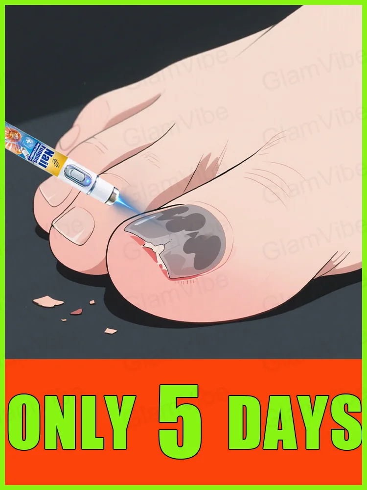 

2025 New Upgraded Version of Blue Laser Nail Fungus Treatment Tool