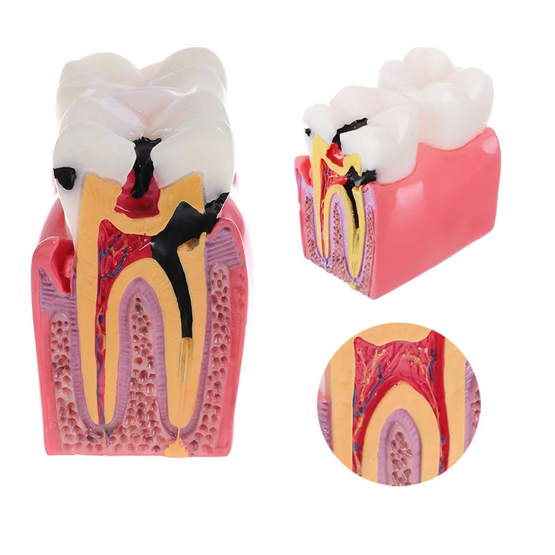 Dental Teeth Model 6/8 Times Caries Comparsion Study Denture Model Dentistry Anatomy Teaching Model Dentist Demonstration Model