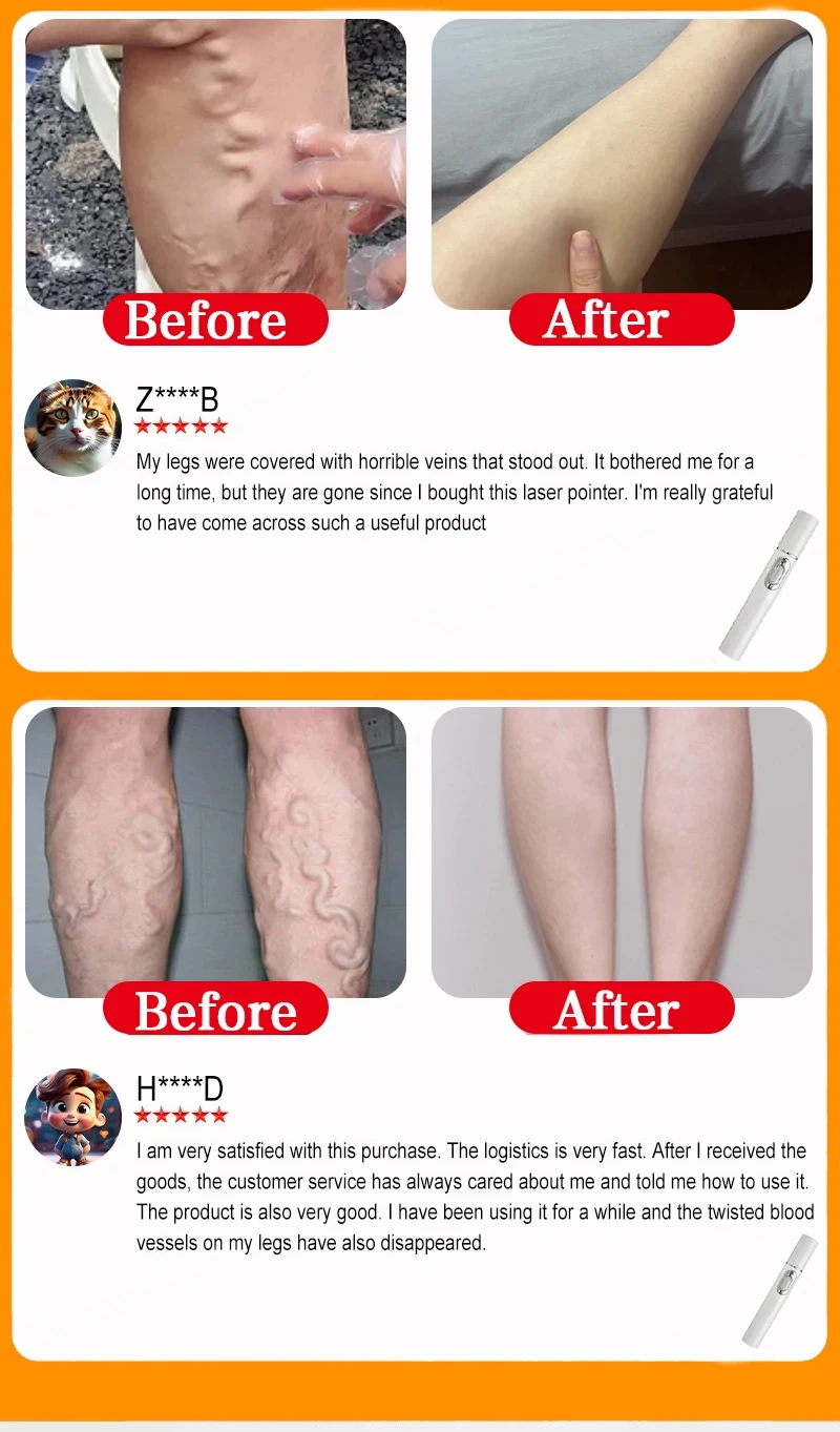 Varicose Vein Lampshade Therapy Effective Improved Blood Circulation Relief Of Dilated Vasculitis In The Legs Phlebitis New