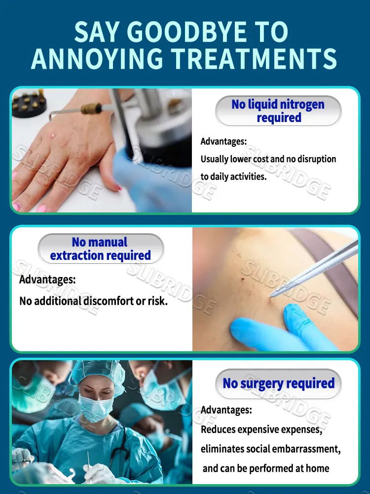 사마귀 치료 도구 블루 라이트 펜은 사용하기 쉽습니다