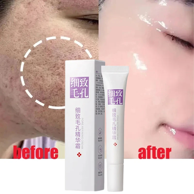 

Nicotinamide Face Cream 20g Freckle Acne Removal Skin Whitening Face Moisturizing Hydrating Fade Stain Anti Wrinkle Cream