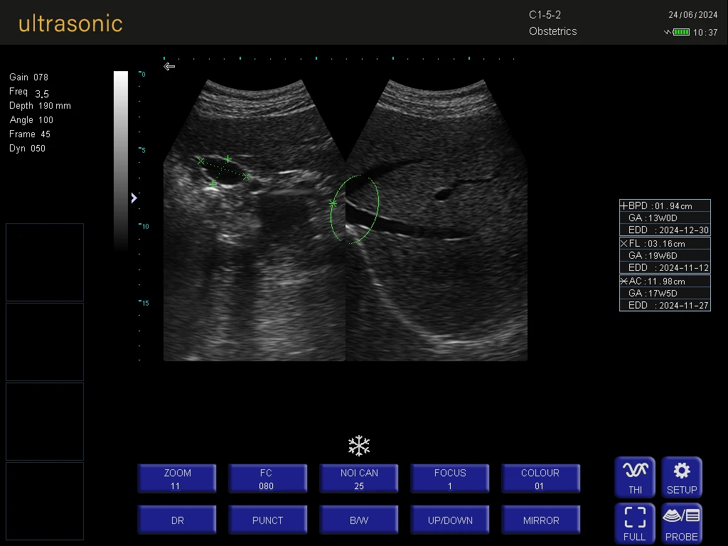 New Upgrade 15 Inch LED Human Use Laptop Notebook Sonography USG Ultrasound Scanner Diagnostic Echo Machine