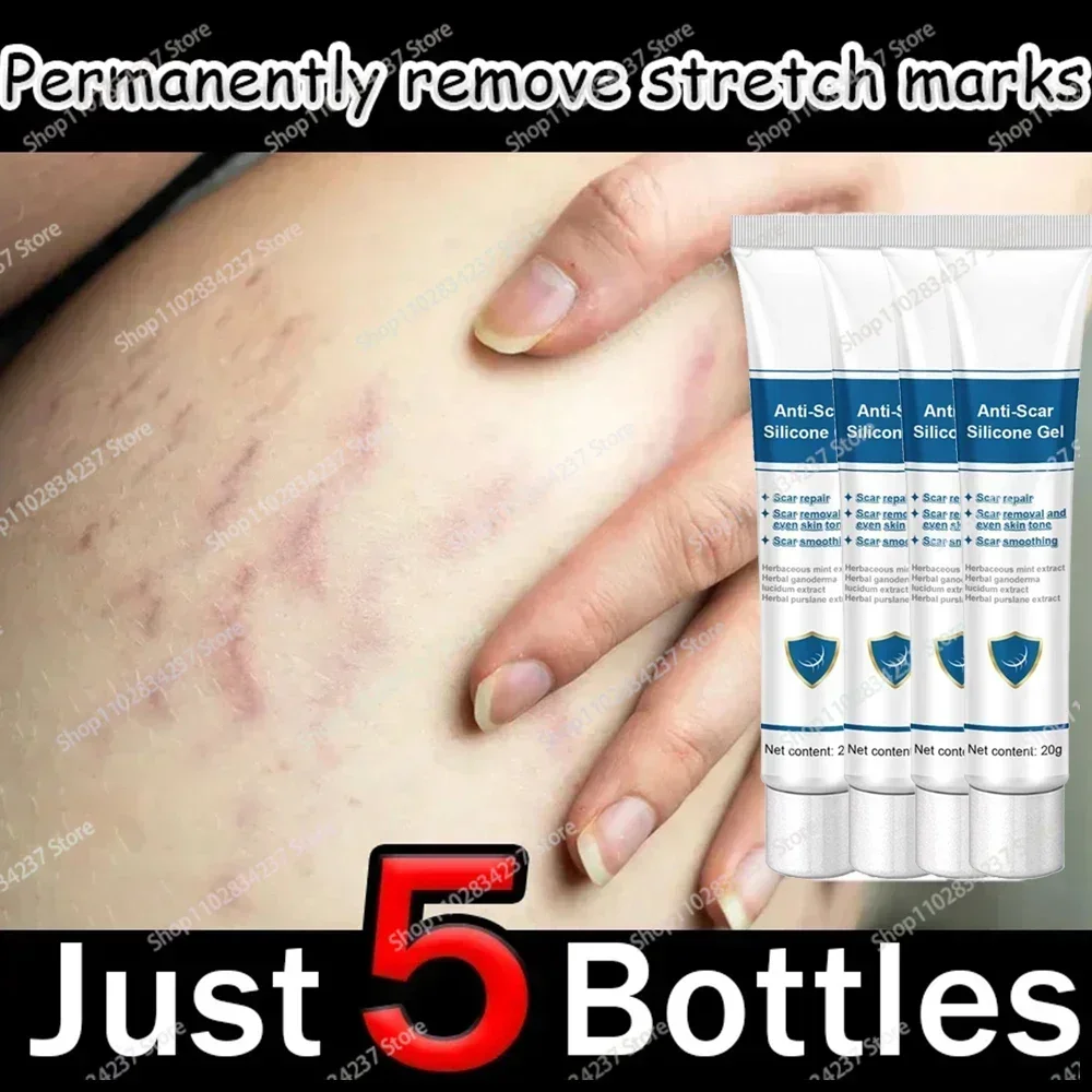 

Stretch Mark Remover Permanent Stretch Mark Remover stretch marks remove scars 1006