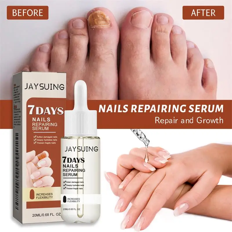 Nail Repair Serum 7 Days Repair 2ml Strong Nail Fungus Treatment Toenail Repair Serum Anti-infective Toe Fungus Removal