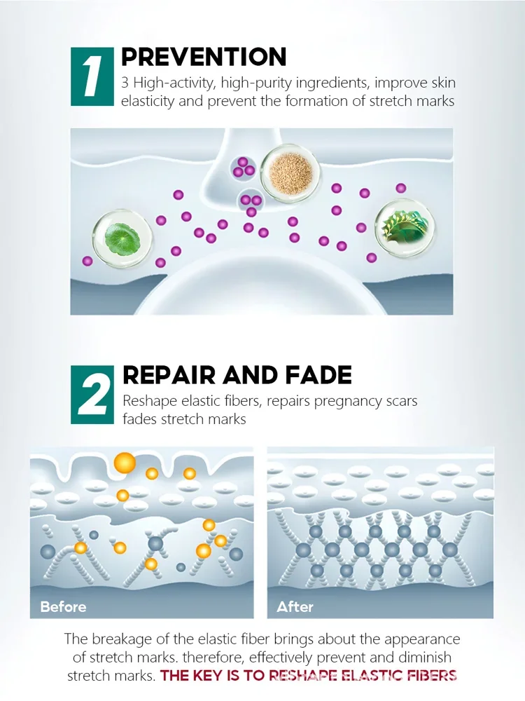 كريم إزالة علامات التمدد كريم إصلاح بعد الولادة للنساء الحوامل علامات نمو السمنة علامات الفخذ لشد البشرة #3