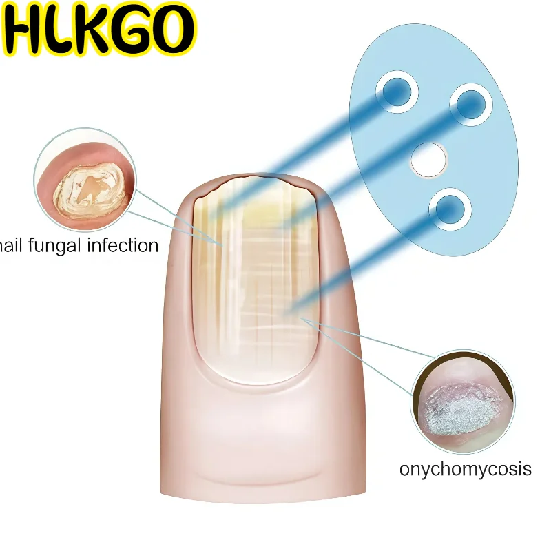 

Профессиональный лазер от грибка ногтей, терапия против грибка 407-910 нм для домашнего использования, перезаряжаемое устройство для ухода за ногтями через USB C