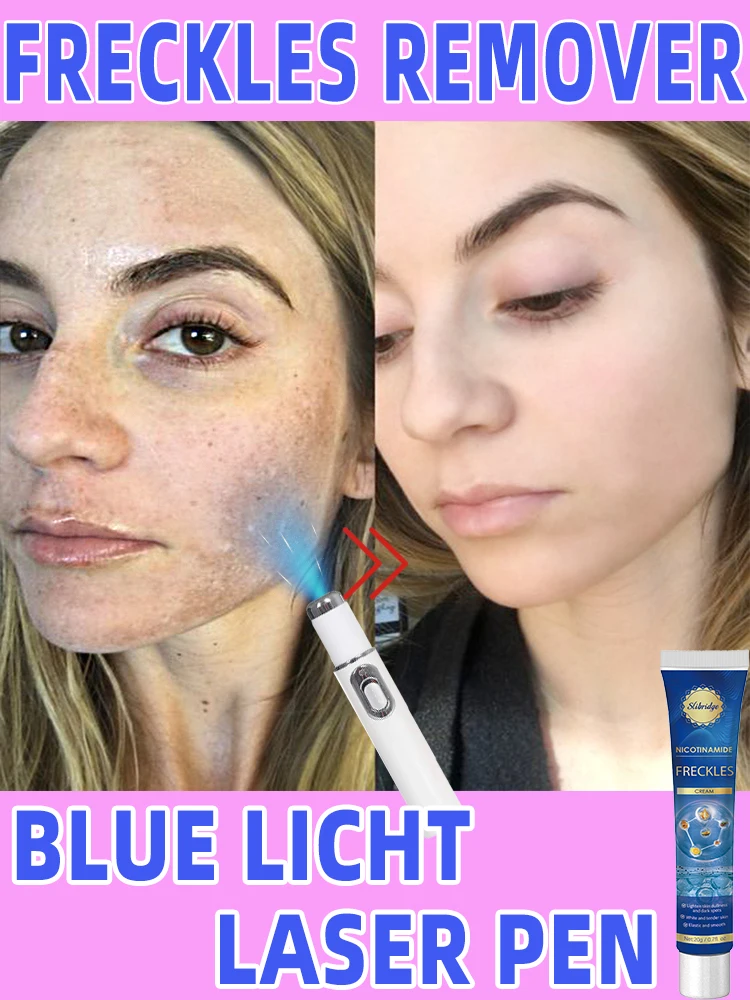 

Laser Chloasma Freckles Age Sun Dark Spot Clear