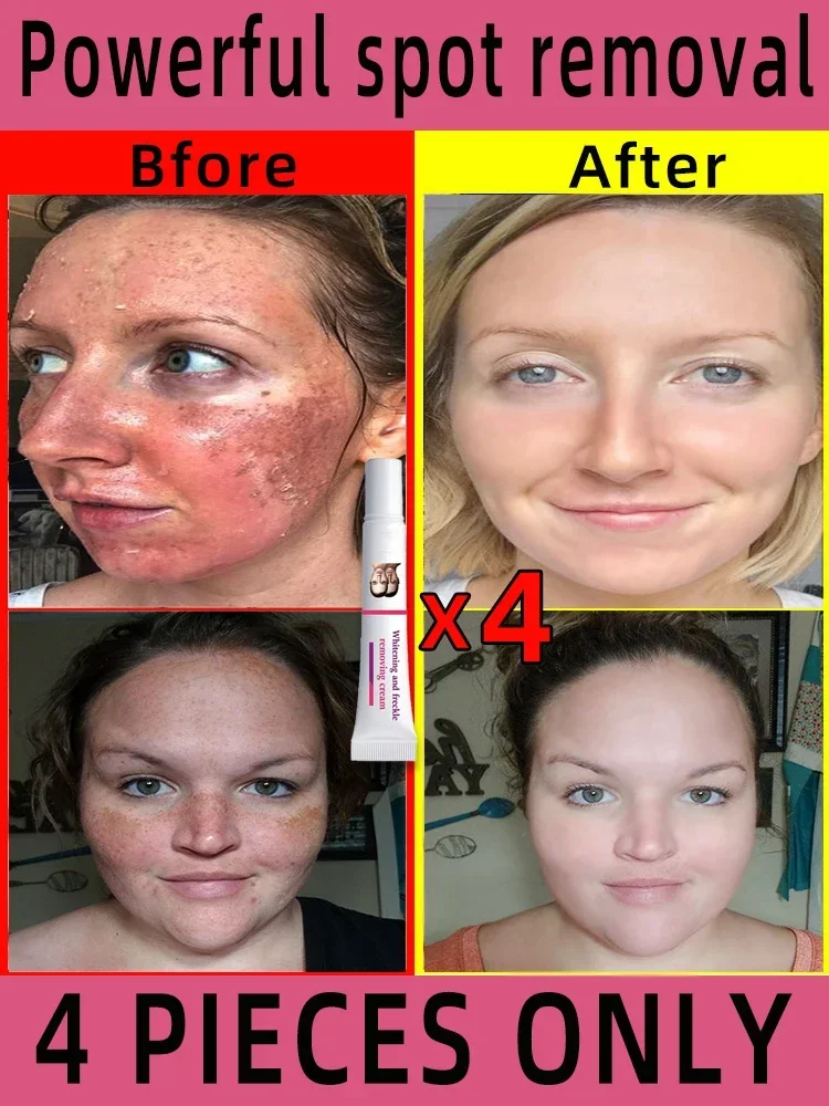 Freckles Removal Cream Remove Facial Spots Skin Dark Spot Remove Melasma Age Spots Sunspots Whitening And Freckle Removing Cream