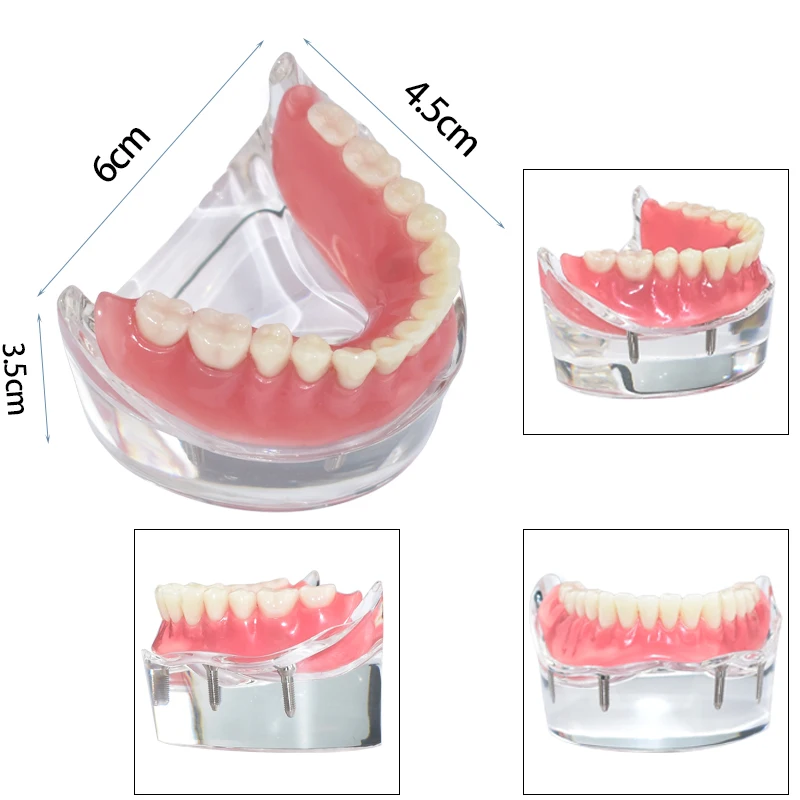 

1Pcs /pack Dental Upper Overdenture Superior 4 Implants Demo Model Teeth Model Dentist Student Learning