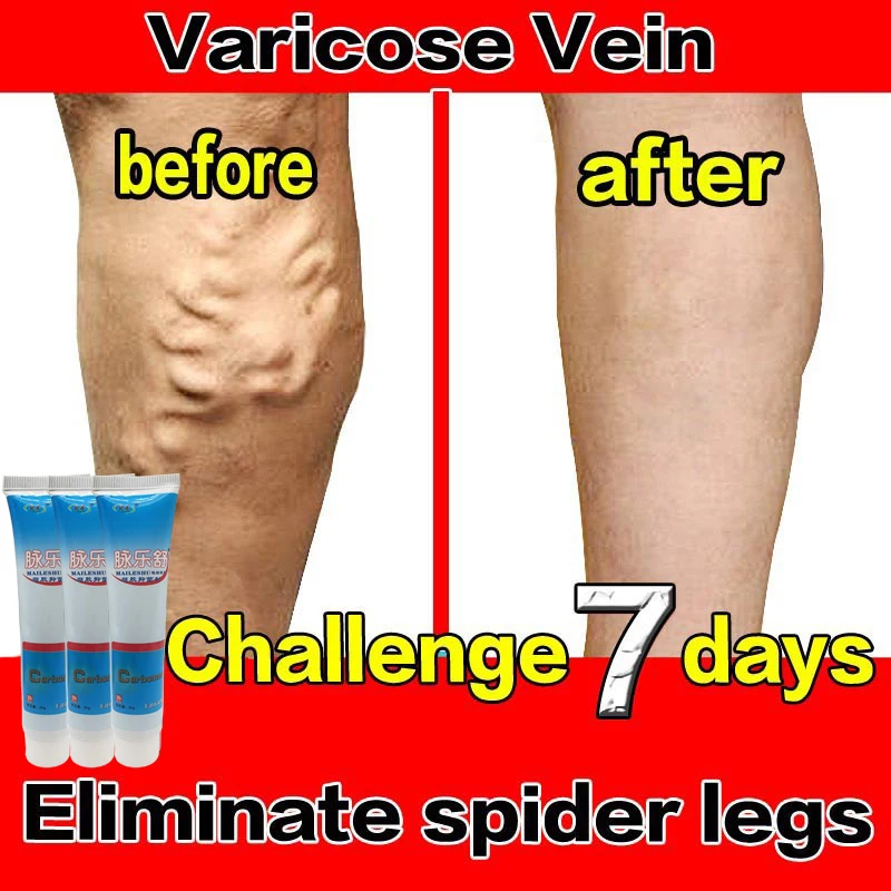 1/3/5/10/22pcs Varicose Vein Treatments Cream Effective Relieve Legs Dilated Vasculitis Phlebitis Natural Formula Ointment