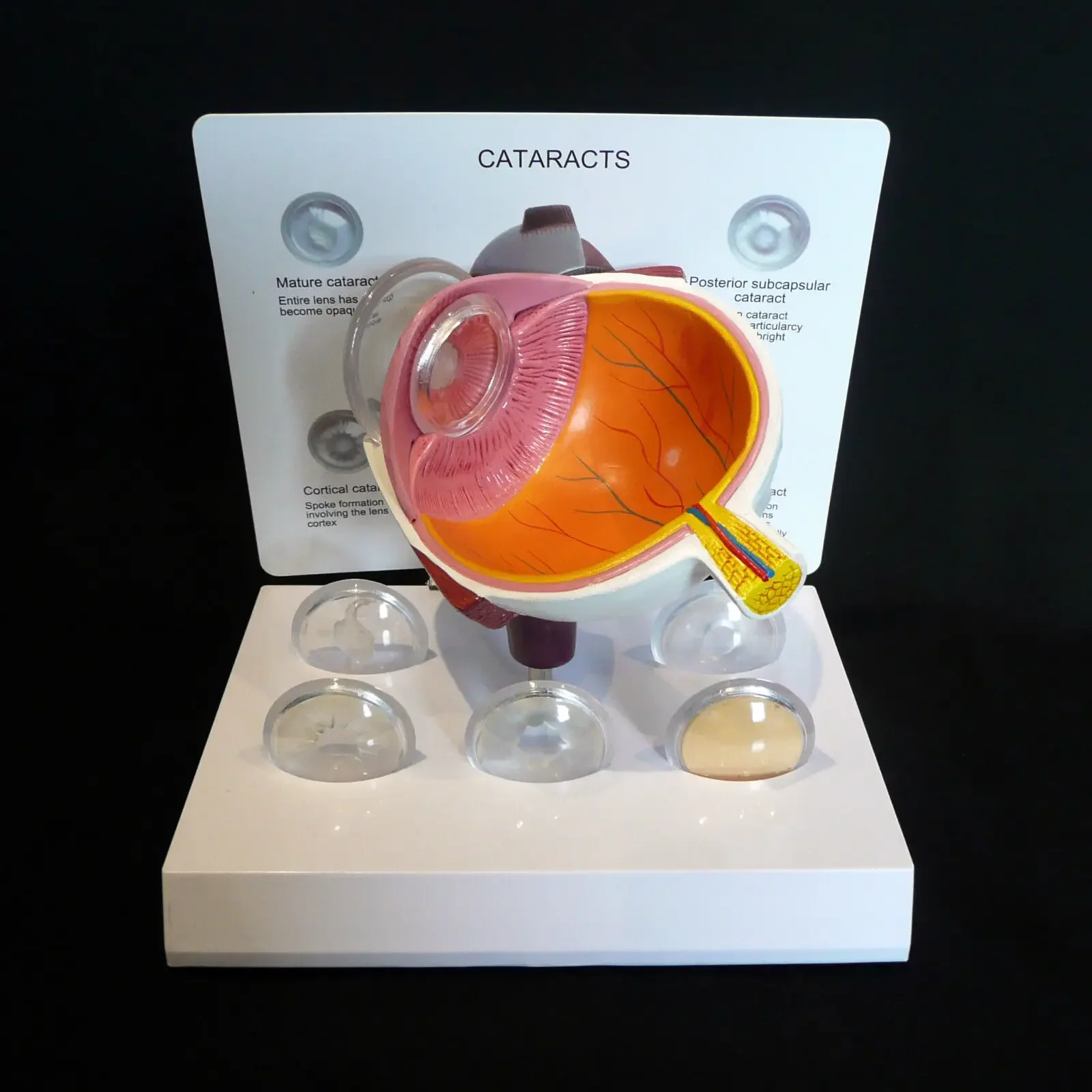 Human Eyeball Lesion Model Pathological models, Eye enlargement Model