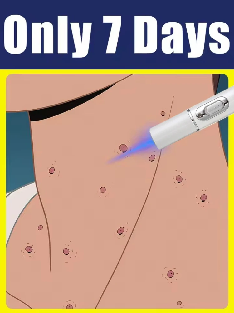 

Outil Wart Blue Light, плюс комплект сцепления Sur Les