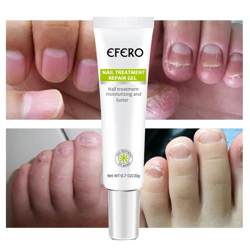 

20ml Nail Cream Treatment Repair Gel Moisturizing and Luster toenail repair, nail repair maintainance ,Promotion