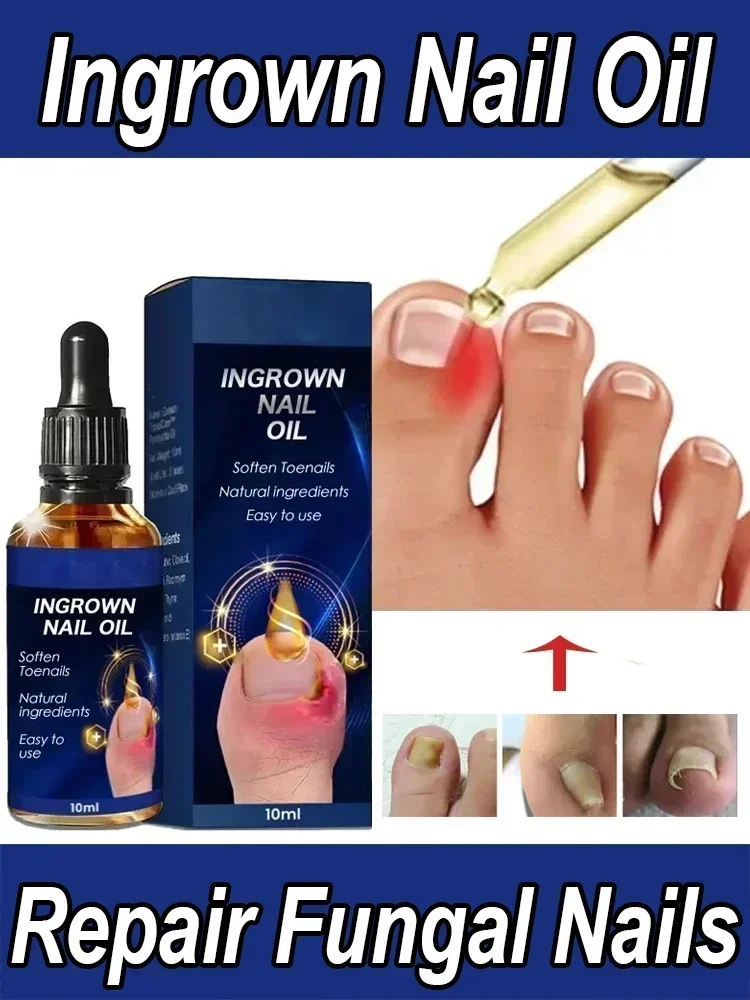 

Fungal Nail Treatment Essence Oil Foot Repair Toe Nail Fungus Removal Gel Anti Infection Cream Fungal Nail Removal