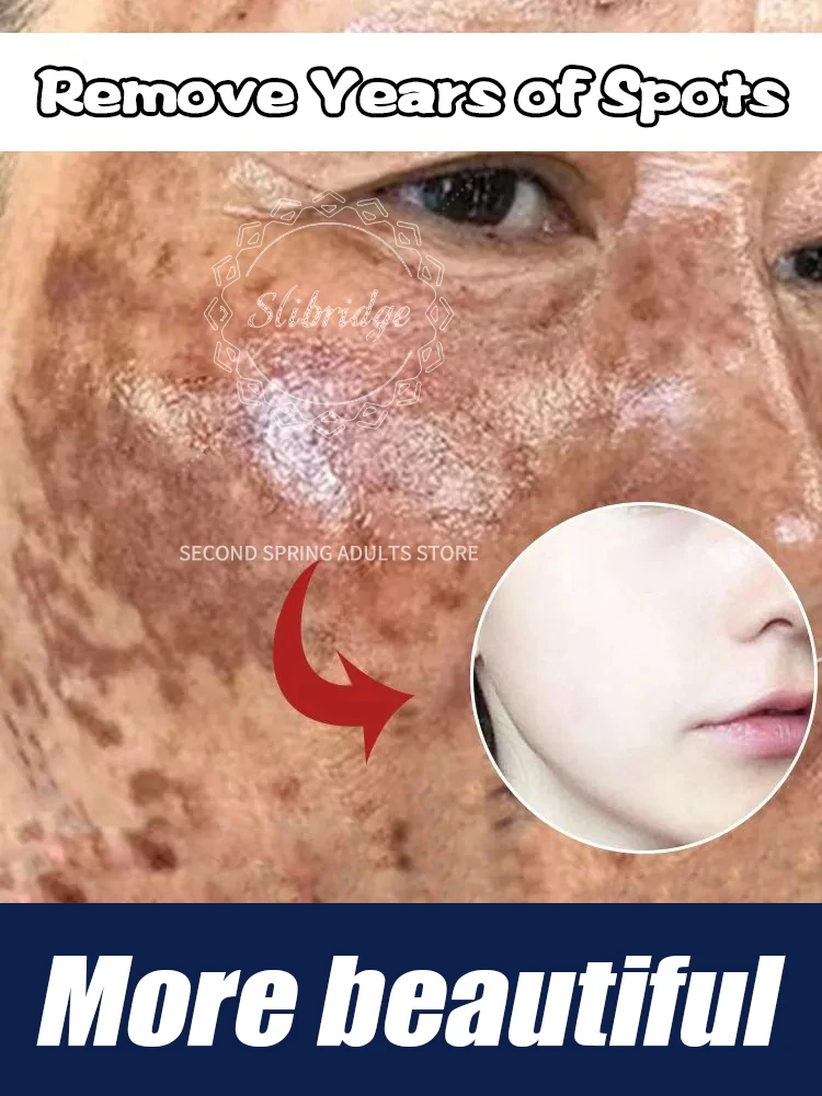 Verkauf Gesichtspflege-Tools lösen Melasma Dark Spots Fast Skin Lightening Geeignet für alle Altersgruppen Mehrere Angebote