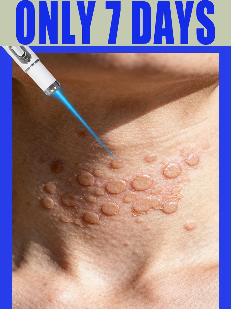 

Home Use WART Care Blue Laser Pen Get it Off WART Say goodbye to WART