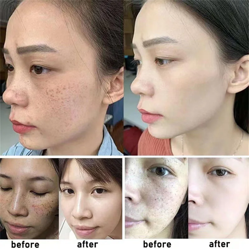 Freckle Whiten Cream Effective Removing Spot Eliminate Brown Stain Melasma Melanin Blemishes Lighten Moisturiser Face Skin Care