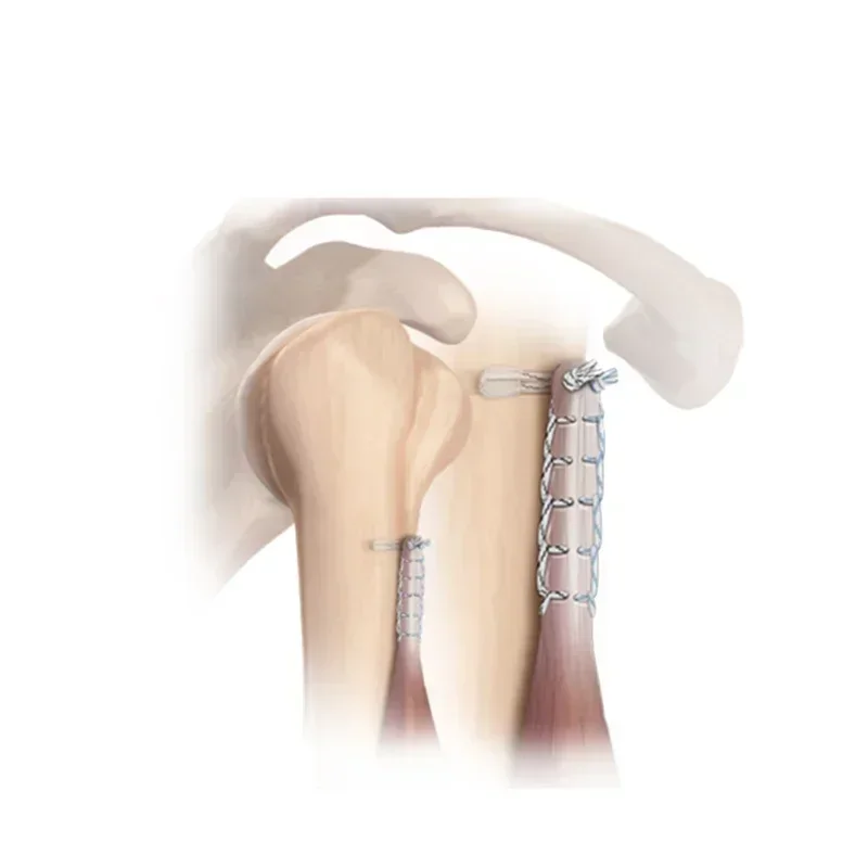 Sports medicine rotator cuff repair, peeling anchor, non absorbable suture anchor, small joint suture anchor