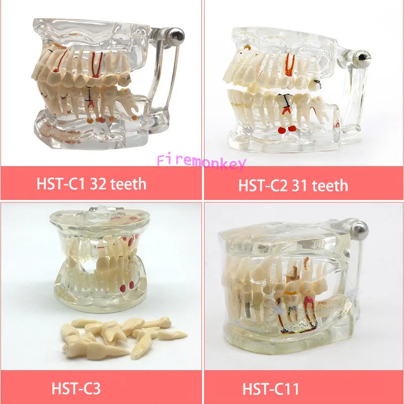 Dental teaching restoration doctor-patient communication model comprehensive case model removable dental mold implant