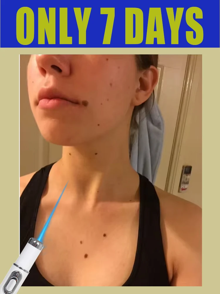 

at home used Blue Laser Solve Wart Tool care wart gentlely