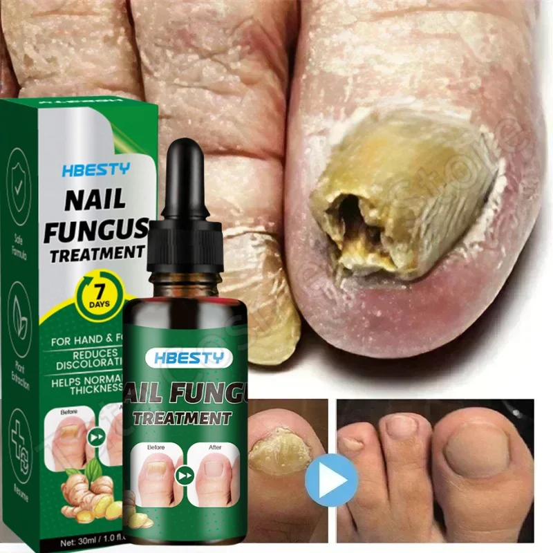 

Nail Fungal Repair Serum Foot Toe Nail Fungus Removal Essential Oil Anti Infection Onychomycosis Paronychia Repairing Care