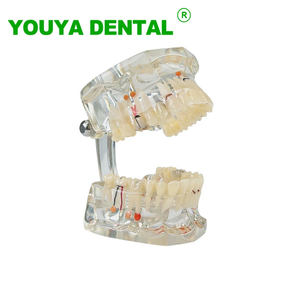 

Dental Teaching Model Pathological Typodont Teeth Model Dentistry Equipment Dentist Student Study Training Demonstration Models