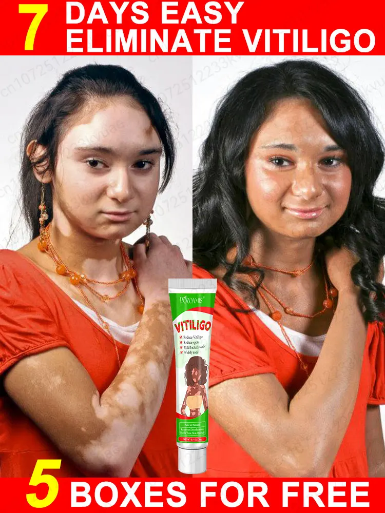 

Эффективно удаляет мазь от витилиго, белые пятна, удаляет витилиго, устраняет уход за кожей витилиго.