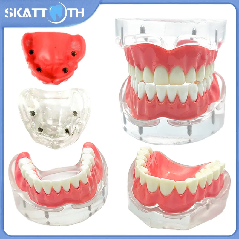 Dental Implant Model Upper/Lower Jaw Removable Implant Model With 4 Implants Overdenture Restoration Model Oral Teach Research