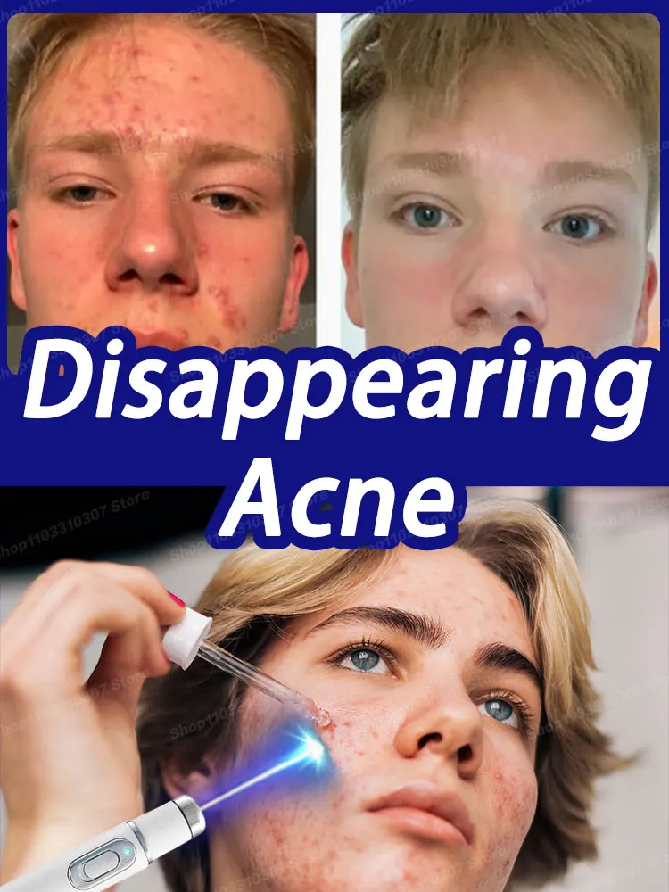 

Acne Anti Pimple Marks Serum Remedy