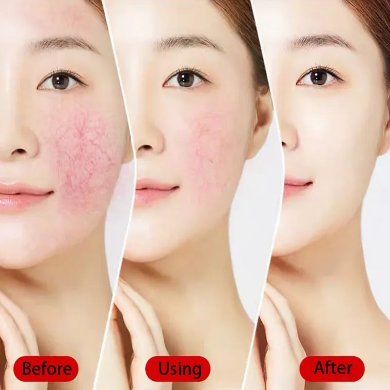 7 Tage Reparatur Gesichts rötung Creme beruhigende Rötung Reparatur Haut Rosacea rotes Blut verbessern empfindliche Hautpflege koreanische Kosmetik