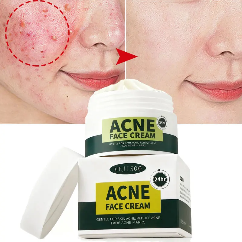 

Salicylic Acid Acne Treatment Cream Anti-Acne Scar Fading Blemish Relief Deep Cleaning Oil Control Moisturizing Repair Skin Care