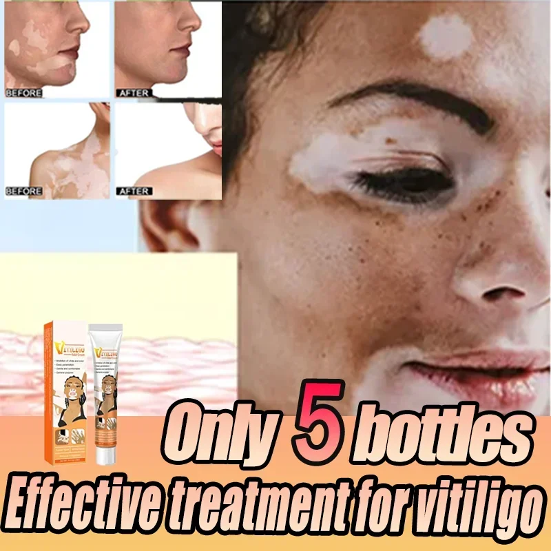 White Spot Cream for Vitiligo White Spots Leukoplakia Pigmentation Melanin Promoting Vitiligo Cream Skin Care