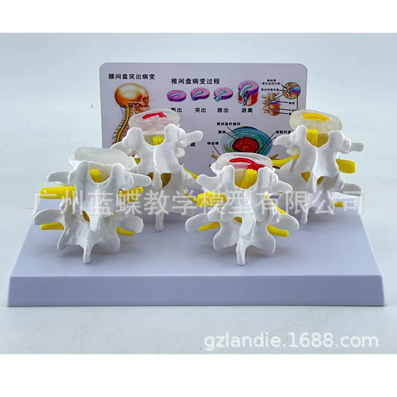 Skeleton Anatomical 4-stage Osteoporosis Vertebrae Anatomical Model Nursing Model Skin In Trauma Lumbar Degeneration Model