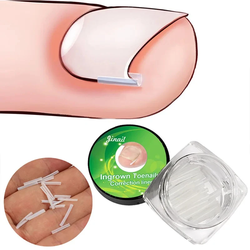 10pcs/box Ingrown Toenail Correction C-shaped Nail Groove Pads Cuttable Nail Orthopedic Clip Brace Pain Relief Foot Care Tool