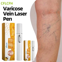 Varicose Veins Pen Laser Therapy Improves Moderate Varicose Vein Improve Blood Circulation Relieve Leg Pain For Men And Women