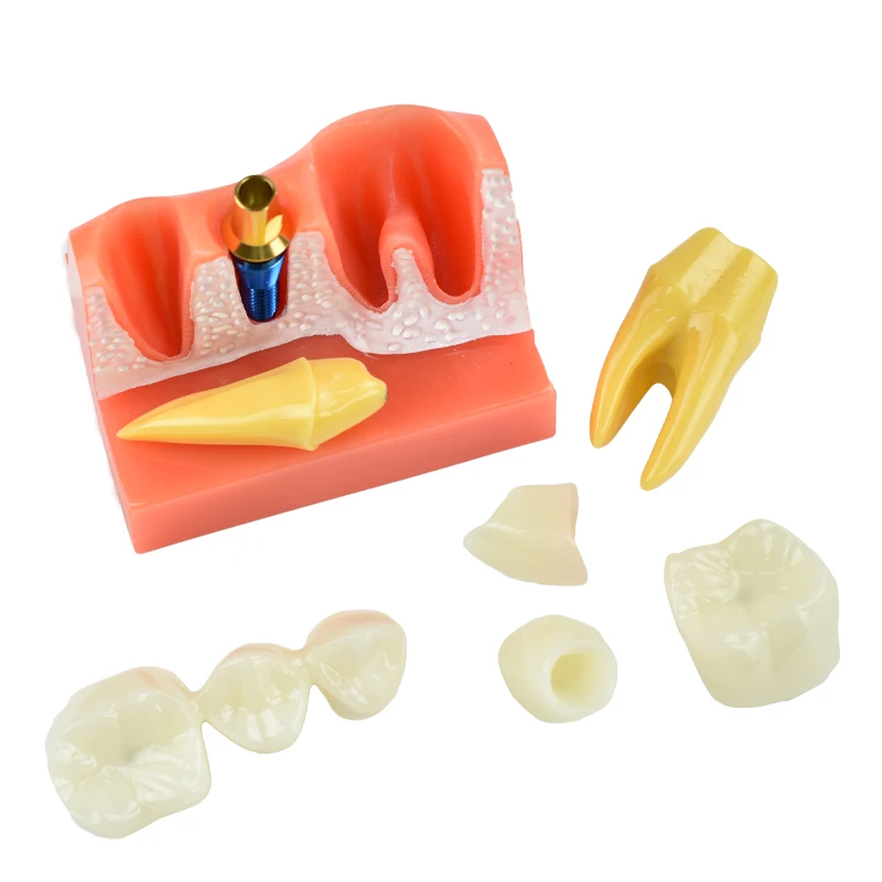 Dental Teach 4 Times Implant Analysis Crown Bridge Removable Model Dental Demonstration Teeth Model Dentisty Lab Material