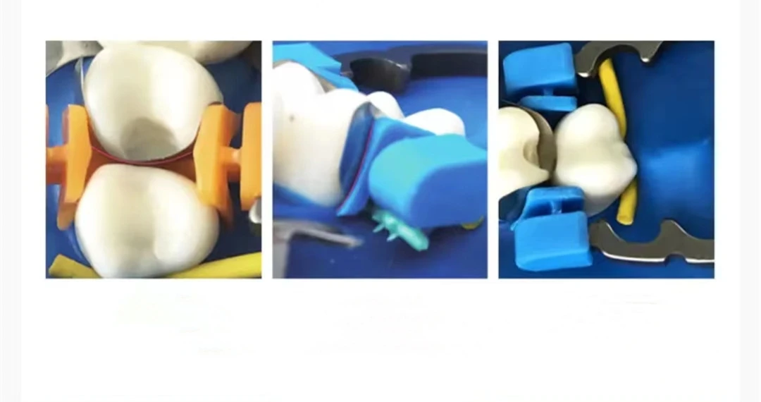 Dentales Sektionalmatrizensystem A2 Metallmatrizen NITI Klemm- und Trennring Keilmesser Diamantkeile Zangen Zahnmedizinisches Werkzeug – Detail 3