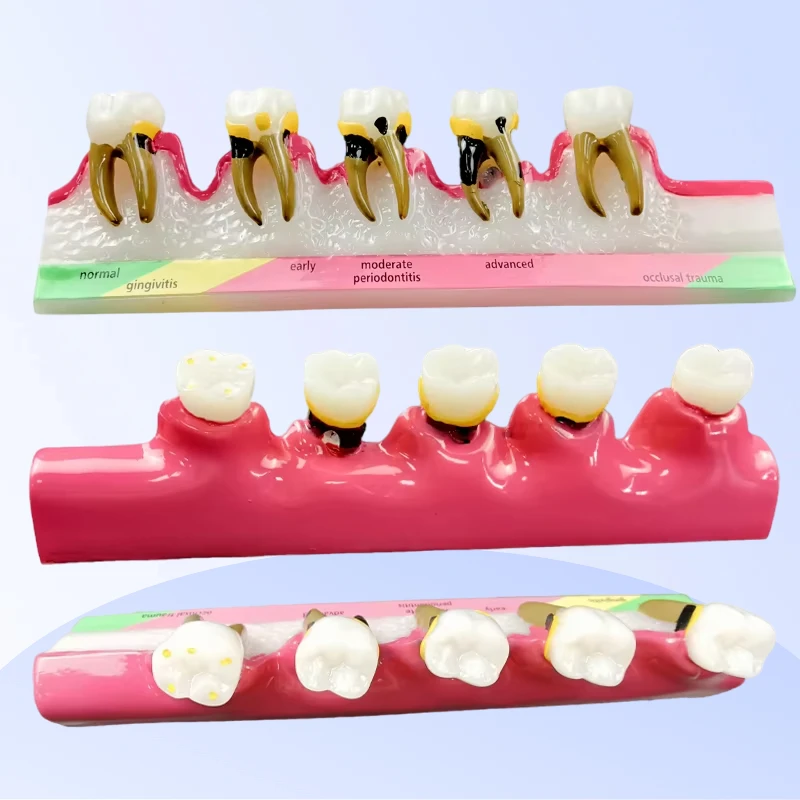 

Демонстрационная модель классификации заболеваний пародонта, 5-ступенчатые обучающие инструменты для студентов-медиков