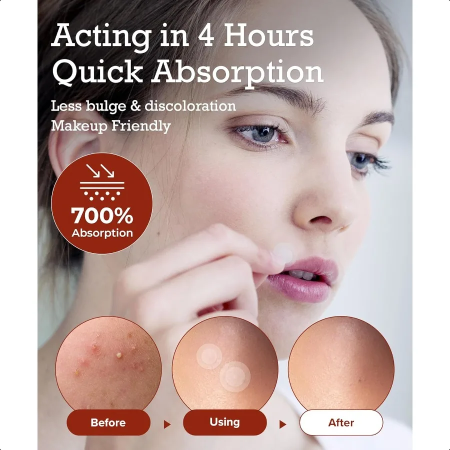 얼굴용 여드름 패치 2팩 총 220개 도트와 2가지 종류의 팝퍼 도구 포함