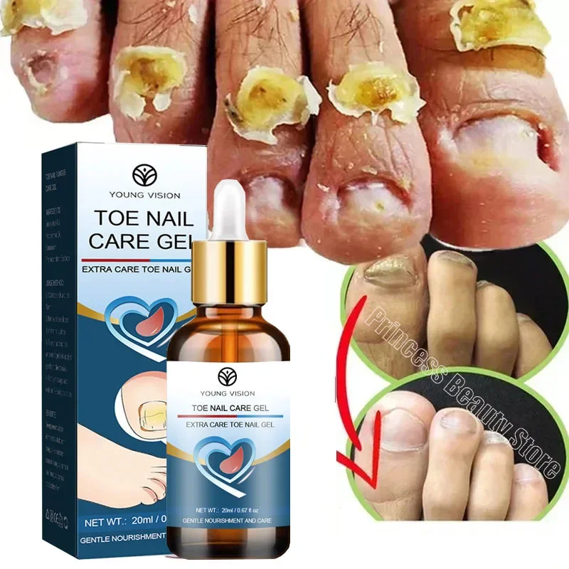 Suero para tratamiento de hongos en las uñas, reparación de pies, líquido para uñas de los pies, Gel de eliminación de hongos, antiinfección, crema de onicomicosis paroniquia, 20ml