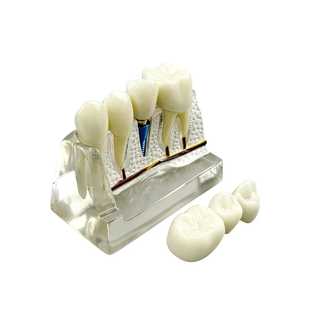 4 Times Dental Implant Model Removable Tooth Dentistry Bridges Crown Study Teeth Model For Teaching Education Demonstration