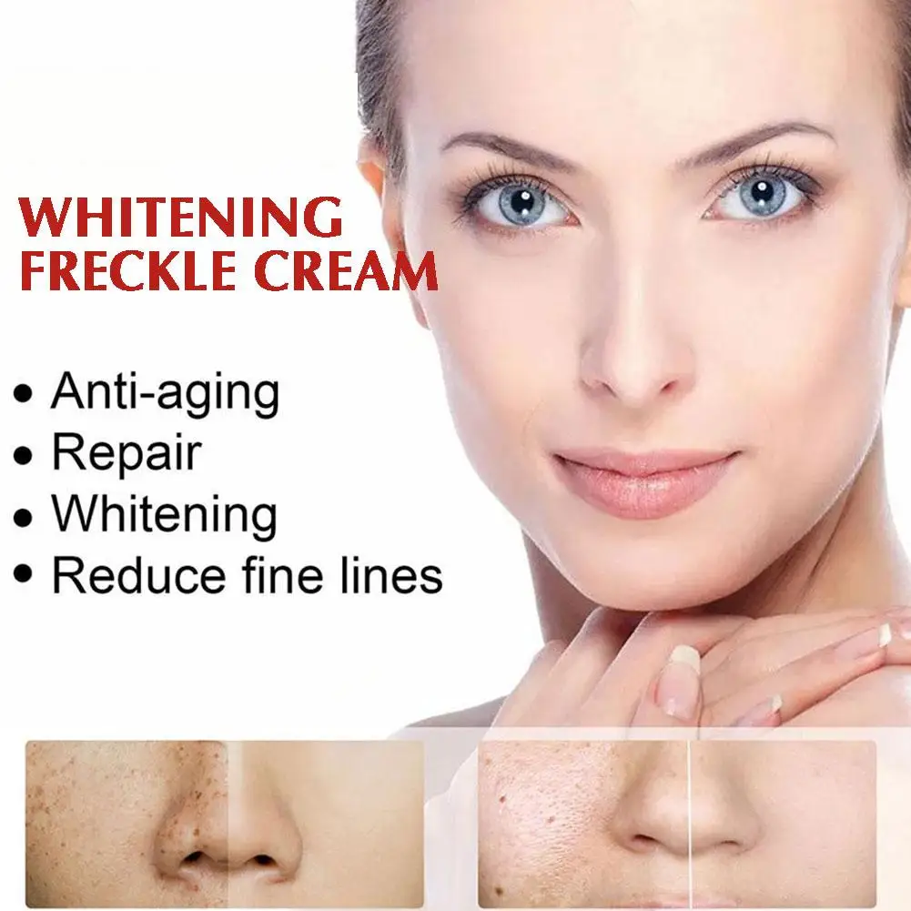 Whitening Freckle Face Cream, Remover manchas escuras, Cremes Anti Freckle, Niacinamida Fade Pigmentation, Melasma Ilumina Cuidados com a pele, 20g