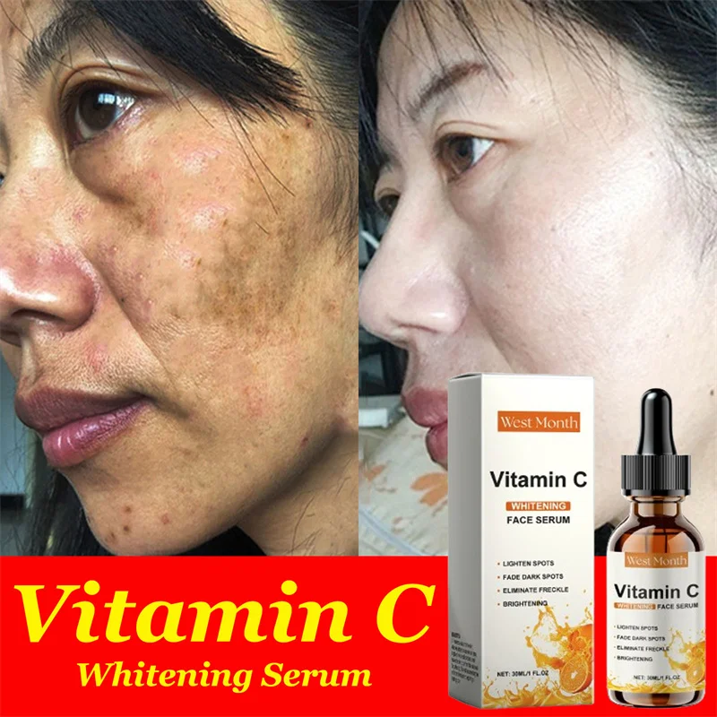 

Vitamin C Whitening Serum Remove Freckles Dark Spots Face Essence Fade Melasma Melanin Brighten Repair Dull Skin Care Cosmetics