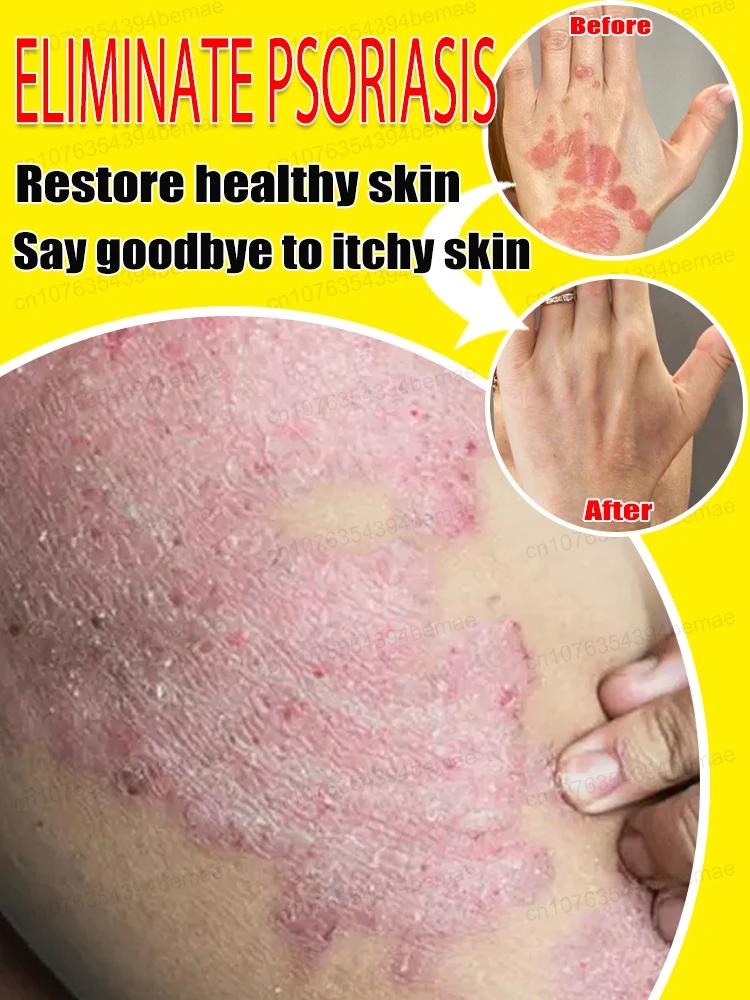 Healthy skin, happy self  ᴏᴠᴇʀᴄᴏᴍᴇ ɪᴛᴄʜɪɴɢ, ᴄᴏᴍғᴏʀᴛᴀʙʟᴇ ᴇᴠᴇʀʏ ᴅᴀʏ