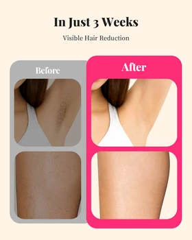 990k Flashes IPL Laser Hair Removal - Professional Permanent Solution for Body, Bikini & Face 10